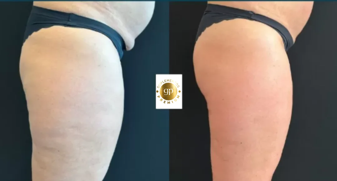 Antes e depois real na firmeza da pele com Lipo.Celulite GoPure